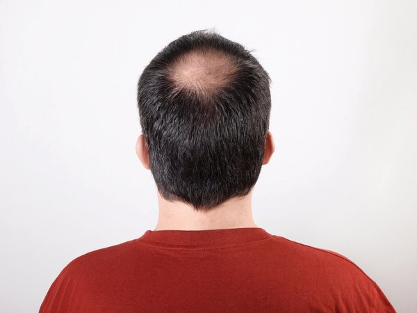 Perte de cheveux homme : stratégies pour retrouver confiance